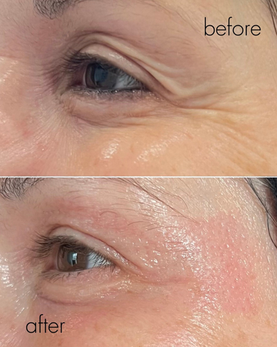 kraaienpootjes_ogen_verminderen